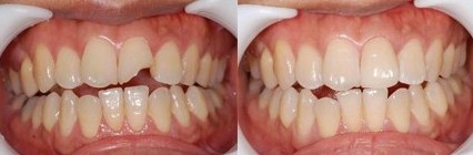 烤瓷牙修复前后对比图