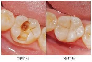 蛀牙补牙前后对比图