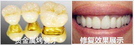 贵金属烤瓷牙450.jpg