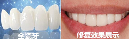 全瓷牙_副本450.jpg